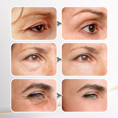 LIMETOW® Instant Eye Cream Tightener✨
