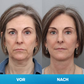 LIMETOW® Unsichtbares Facelift-Tape