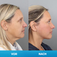 LIMETOW® Unsichtbares Facelift-Tape