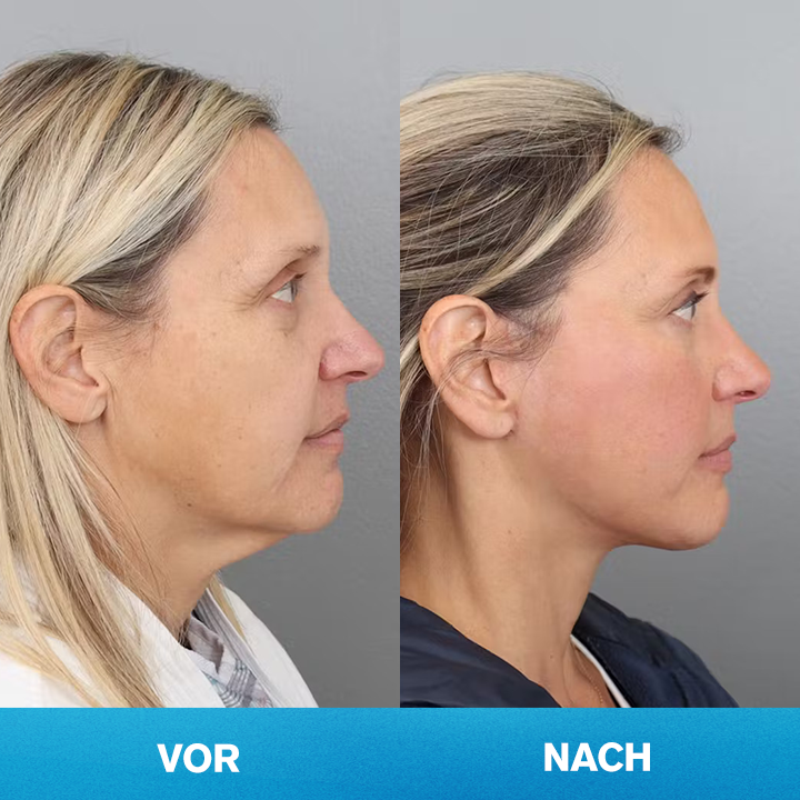 LIMETOW® Unsichtbares Facelift-Tape