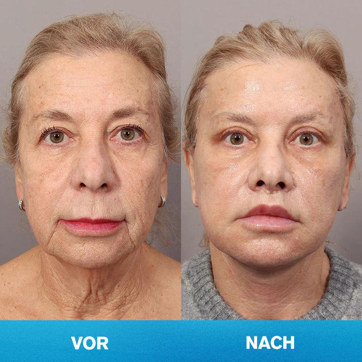 LIMETOW® Unsichtbares Facelift-Tape